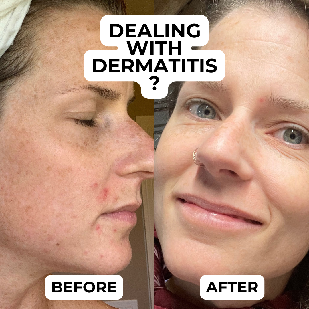 skincare for dermatitis prone skin before and after