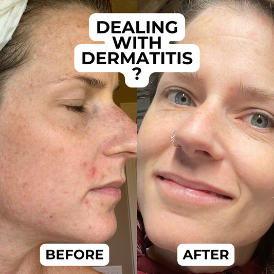 skincare for dermatitis prone skin before and after