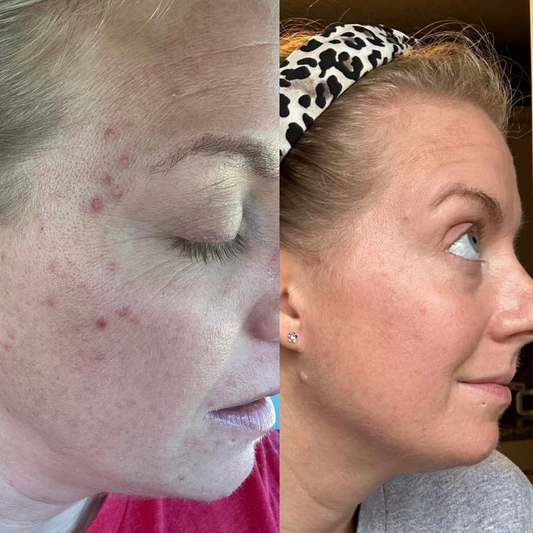 How I Actually Healed My Acne (And My Perioral Dermatitis) Naturally